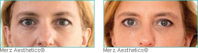 Injections pour combler les cernes