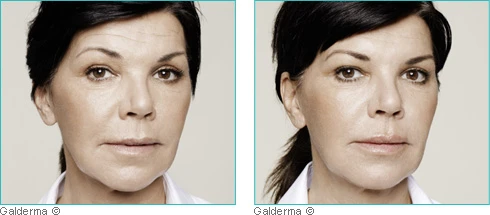 Restylane Skinbooster pour les peaux matures